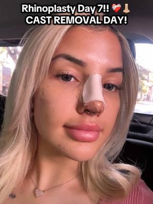 Sorry i took a week to post this update! 🥲🫶🏼🫶🏼 That same day i flew home to Texas! So I’ve been getting back in my groove and being a mommy. 🫶🏼 Any questions drop them down below 💞💞💞 #rhinoplasty #recovery #nosejobcheck #rhinoplasty #journey #nosejob #mexico #gdl #plasticsurgery #fyp #foryoupage #drluissandoval 