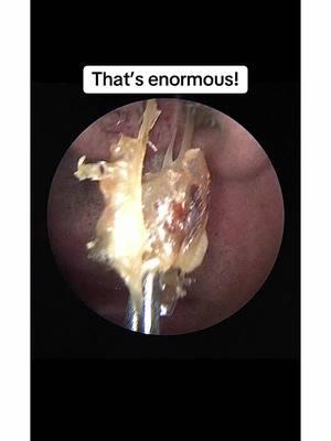 Can you believe the size of that nasal crust?  Thats one enormous booger removal!  Coulda easily been avoided with @Narisure Dry Nose Relief #booger #snot #nose #oddlysatisfying #doctor #medical #asmr 