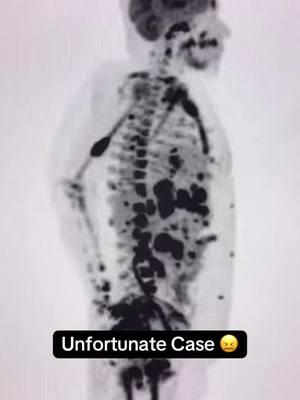 This is a terrible and unfortunate case of widely metestatic cancer. This was a PET scan looking for abnormal uptake anywhere else in the body. The dark black areas are cancer.. it is everywhere and in every organ.. including the bones. I am so sorry. #nurses #doctor #nurse #fyp #fypシ #doctorsoftiktok #nursesoftiktok 