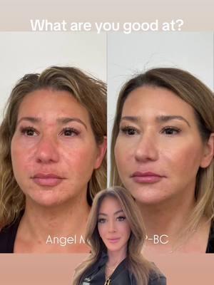 Like making you look more rejuvenaged. #botoxinjection #facialbalancing #facialsculpting #jawlinefiller #botox #dysport #fillers #lipfiller #aesthetics #nursesoftiktok #nursetok #facialbalancing  #nursepractitioner #np #nurse #rn #nurseinjector #nurselife #aesthetics #aestheticnurse #nursingschool #nursingstudent #medicine #medschool #plasticsurgery #cosmetics #fyp #fy #fypシ #lipflip #grwm #beauty #njmedspa #medspanj #lipfiller #chinfiller #cheekfiller #bergencountymom #bergencountymoms #njmedspa #lookyounger #njinjector #nurseinjector #wrinkles #botoxnurse #njbotox #botoxnj #medspanj 