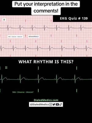 🫀🧱🤔 All #EKG recordings are from the EKG rhythm generator on my website (LII rhythms only for now, 12Ls are in beta and coming soon), be sure to check it out for more software generated #ECG practice! (Link in bio.) #EMS #ACLS #emstok #paramedic #paramedicsoftiktok #medic #medicsoftiktok #flightmedic #criticalcareparamedic #paramedicstudent #paramedicschool #emta #emtb #emt #emtlife #emtsoftiktok #emtstudent #emtschool #firstresponders #NREMT #nurse #nursesoftiktok #RN #nursingstudent #nursingschool #flightnurse #criticalcarenurse #emergencynurse #NCLEX #nclexrn #nclexprep #doctor #doctorsoftiktok #medicalstudent #USMLE #emergencymedicine #criticalcare #cardiology #FOAMED 