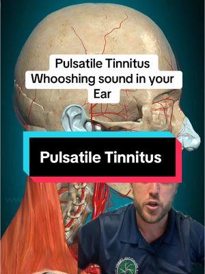 #pulsatiletinnitus #tinnitis #dizziness #fyp 