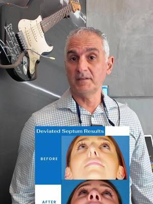 What is a Deviated Septum? 👃 This is when cartilage and bone that separates the nasal cavity, is not straight. In this reel you can see examples of the nostrils in these patients. Before and after a surgery to correct this. When both nostrils are open and clear then we can get the proper oxygen to flow throughout our body. Did you check your nostrils now to see? #deviatedseptum #nostril#nostrils #breathe #nosebreathing #oxygen#breathedeep #completehealthdentistry #drnassery #completehealth #miamidentist #sleepdentist #tscan #