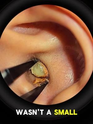 #earwax #relax #acne #satisfying #earwaxremoval #asmr #earcleaningvideos #ceradeouvido #earwaxcleaning #earwaxremmoval 