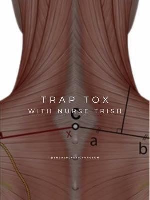 ✨ Say Hello to a Sleek, Defined Neck & Jawline with TrapTox! ✨ Want to target those stubborn neck and shoulder muscles and reveal a more sculpted profile? TrapTox is here to help! 💉 This non-surgical treatment relaxes the trapezius muscles, giving you a smoother, more defined neck and jawline—without the downtime! ✅ What is TrapTox? A simple Botox or Dysport injection to relax the trapezius muscles in the neck and shoulders, creating a more contoured, elegant look. ✅ Why You’ll Love It: • Less tension in the neck and shoulders • A more defined neckline and jawline • Quick, minimally invasive, and virtually no recovery time! Perfect for those looking to enhance their natural features without surgery. 🌟 Ready to enhance your profile and feel your best? DM us to learn more! #Medspa #TrapTox #Dysport #Botox #Toxins #Neurotoxins #BeautyTrends #InjectorLife #Beauty #SwanNeck #PainManagement #Upland #Injections #Education