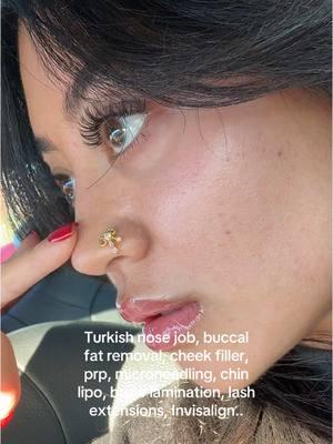 The typa sh*t im on you wouldnt understand  #cosmeticprocedures #turkishnosejob #rhinoplasty #buccalfatremoval #filler #chinlipo 