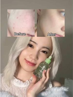 This was such a lifesaver when I waxed my face bc I get breakouts all the time but now I know what to apply :) its called Abib Heartleaf Teca Serum #abibcapsuleserum #essence     #ampoule #acneserum #noncomedogenic #acneproneskin    #acnescar #redness #blemish     #pimple #heartleaf #teca #acnetreatment    #kbeauty    #koreanskincare    #acnejourney #fyp#creatorsearchinsights 