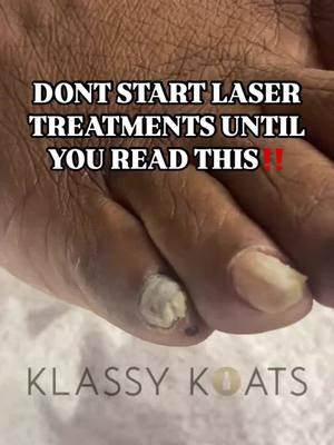 Laser treatments 🥽 for toenail fungus is a great alternative to oral medicine but should be paired with a wellness/medical pedicure for the best results.  While the laser treatment targets 🎯 and destroys the toenail fungus, it does not aid in the immediate aesthetic of the toenail or address the current thickness, dead skin, and debris build up around and under the toenail.  Most laser technicians advise you will need several laser treatments to address the fungus and you still have to wait until the old fungual nail grows out which can take up to a year 😳 Whether you decide to address your toenail fungus with oral, topical, and/or laser treatments, adding a wellness/medical pedicure to your treatment plan can expedite your wellness journey and give you the immediate confidence to  stop covering up your toes 🫣 #lasertreatment #toenailfungus #fungus #toenail #medicalpedicure #houstonpedicure #klassykoats #privatepedicures #medipedi #safesalon #footcare #advancedfootcare #houston #medicalnailtech #wellnesspedicure #houstonnurses #houstondoctors #dallas #sanantonio #austin #beaumont #galveston #seniorfootcare #htxnailtech 