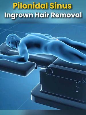 Pilonid Sinus Ingrown Hair Removal Procedure #PilonidalSinus #IngrownHairRemoval #MedicalProcedure #HealthAwareness #PilonidalCyst #SurgicalSolutions  #HealthEducation #MedicalExplained #PatientCare #BodyWellness