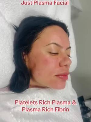 Plasma Facial A PRP facial, or vampire facial, is an in-office skin treatment that harnesses the regenerative benefits of PRP therapy. The procedure begins with a blood draw and preparation of your PRP solution#prp #prf #isabellamiaskincare 