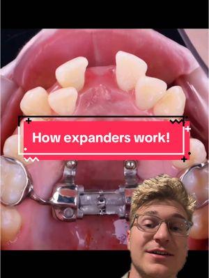 Orthodontic expansion CAN have an impact on the airway and the ability to breath.  In the past, Orthodontists would extract teeth instead of expanding the arch. Extraction of teeth can SOMETIMES decrease the space needed for the tongue. We are now more cautious with extractions and only use them when absolutely necessary and without risk of reducing the airway space.  #orthodontics #braces #expander #sheboygan #manitowoc #orthodontist #teeth #dentistry #dentaltips #fyp #greenscreenvideo 