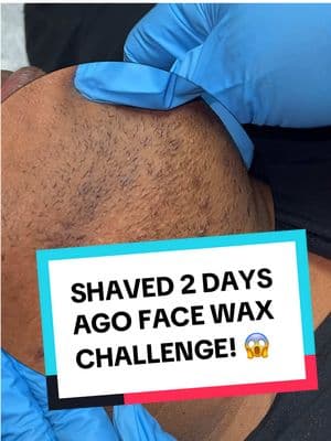 SHORT HAIR PCOS FACE WAX CHALLENGE! USING PLUMERIA BY @Black Coral Wax 🩷💪🏾 ⚠️ please make sure your hair is at least the length of a piece of rice grain before getting waxed. This video is for content purposes only.  #fyp #foryoupage #esthetician #pcos #wax #challenge #satisfyingvideo #viraltiktok #trending #magic #omg #anythingispossible #hirsutism 