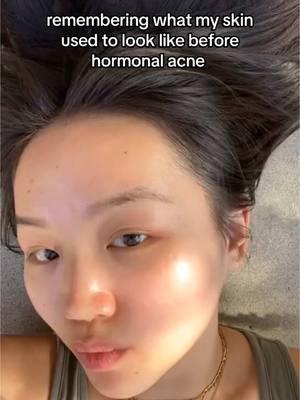 I think about it everyday 🥲 #fyp #viral #relatable #acne #hormonalacne #acnejourney #hormonalimbalance #birthcontrol #clearskin 