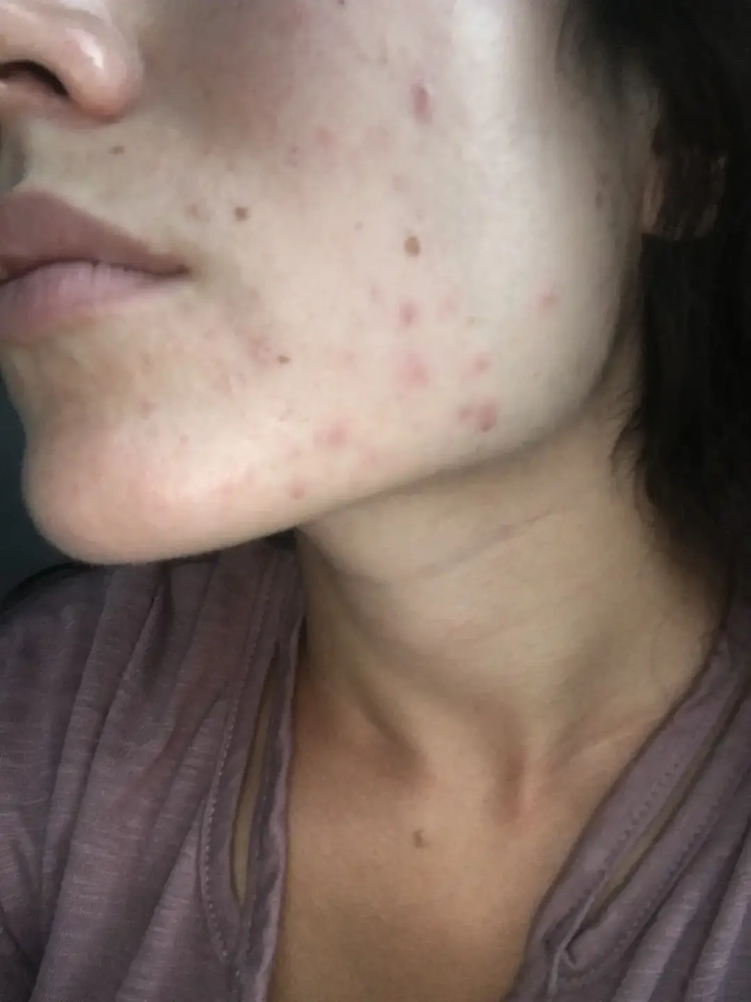 My journey with acne was not a smooth one. I had tried EVERYTHING. Birth control, antibiotics, harsh chemical peels, hundreds of skin routines until I realized the imbalance was stemming from a very unhealthy gut and everything I was trying was worsening that imbalance. Let me know if you guys want me to share what I did to heal my gut and my skin. #acne #gutskinconnection #skinbarrier #dysbiosis #hormonalimbalance #estrogendominance #skincare