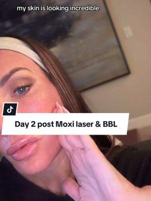 Day 2 post Moxi and BBL laser treatment 2️⃣ @Sarah Bloom  • Definitely more red today and you can see the mends all over. Face is feeling and sounding like sandpaper. So far I’m impressed and looking forward to seeing what the skin underneath will look like!  • #moxilaser #lasertreatment #over40women #skincare #over40skincare #lasers #bbl #takecareofyourskin #aesthetics #progresspic #facesinbloom #fypシ 