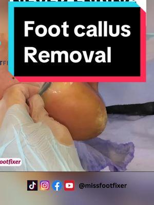 Painful! Never Ending Callus | Miss Foot Fixer | Marion Yau #footcallusremover #footcallus #missfootfixer #footcallustreatment #foottreatment 