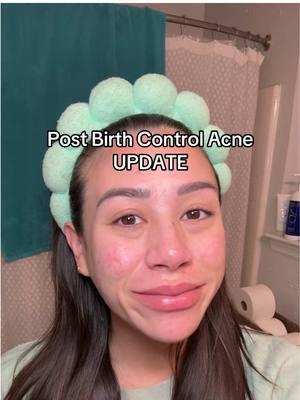 #greenscreen December’s Acne Update 👏🏼 #postbirthcontrolacne #acne #postbirthcontrol #hormonalacne #hormonalacnejourney #acnejourney #acneskin #acneproneskin #acnescars #acnefighter #acnecheck #skincare #skincareroutine #skincaretips #SkinCare101 