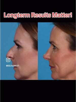 #beforeandafter #longtermresults matter in #rhinoplasty #bestplasticsurgeon @Newsweek #drrodrohrich #fyp #foryourpage #foryoupage #dallas #rhinoplastybeforeandaafter #rhinoplastyexpert 