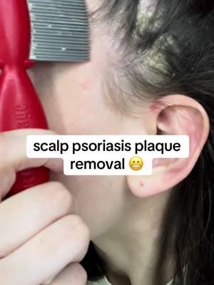 cant escape christmas music mwahahah #psoriasis #scalppsoriasis #psoriasisremoval #satisfyingremoval #Psoriasispatches #scalppsoriasisremoval #psoriasisawareness #psoriasismanagement #psoriasiscommunity #psoriasistreatment #psoriasishelp #psoriasistok #dandruff #dandruffremoval #scalppsoriasisrelief #fyp #foryou #viral #psoriasissatisfying  