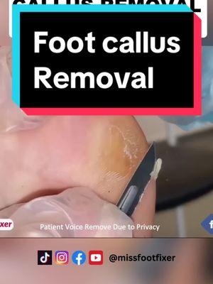 Callus Removal From Feet | Miss Foot Fixer #missfootfixer #footcallusremover #footcallus #footcallustreatment #toenailremoval 