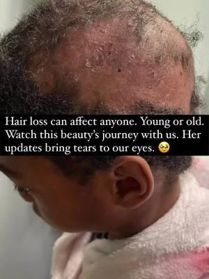 Hair loss will NOT win ‼️🥹 Watch this beauty’s frown turn upside down.  We are beyond grateful to be able to have this type of impact on your lives.  Disclosure: Results may vary.  #hairoil #rosemaryhairoil #baskandlatherco #hairgrowthoil #alopeciahairgrowth 