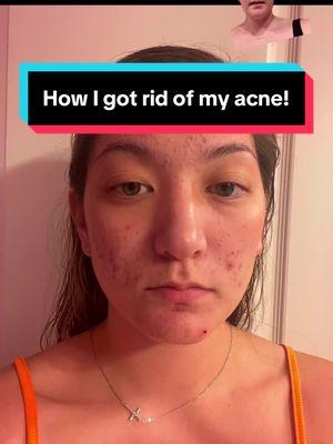 @Decoder US My skins not perfect but I have got rid of most of my acne :) #decoder #skincare #skin #acne #acnetreatment #acneskin #acneproneskin #myskincareroutine #skincareroutine #greenscreen 