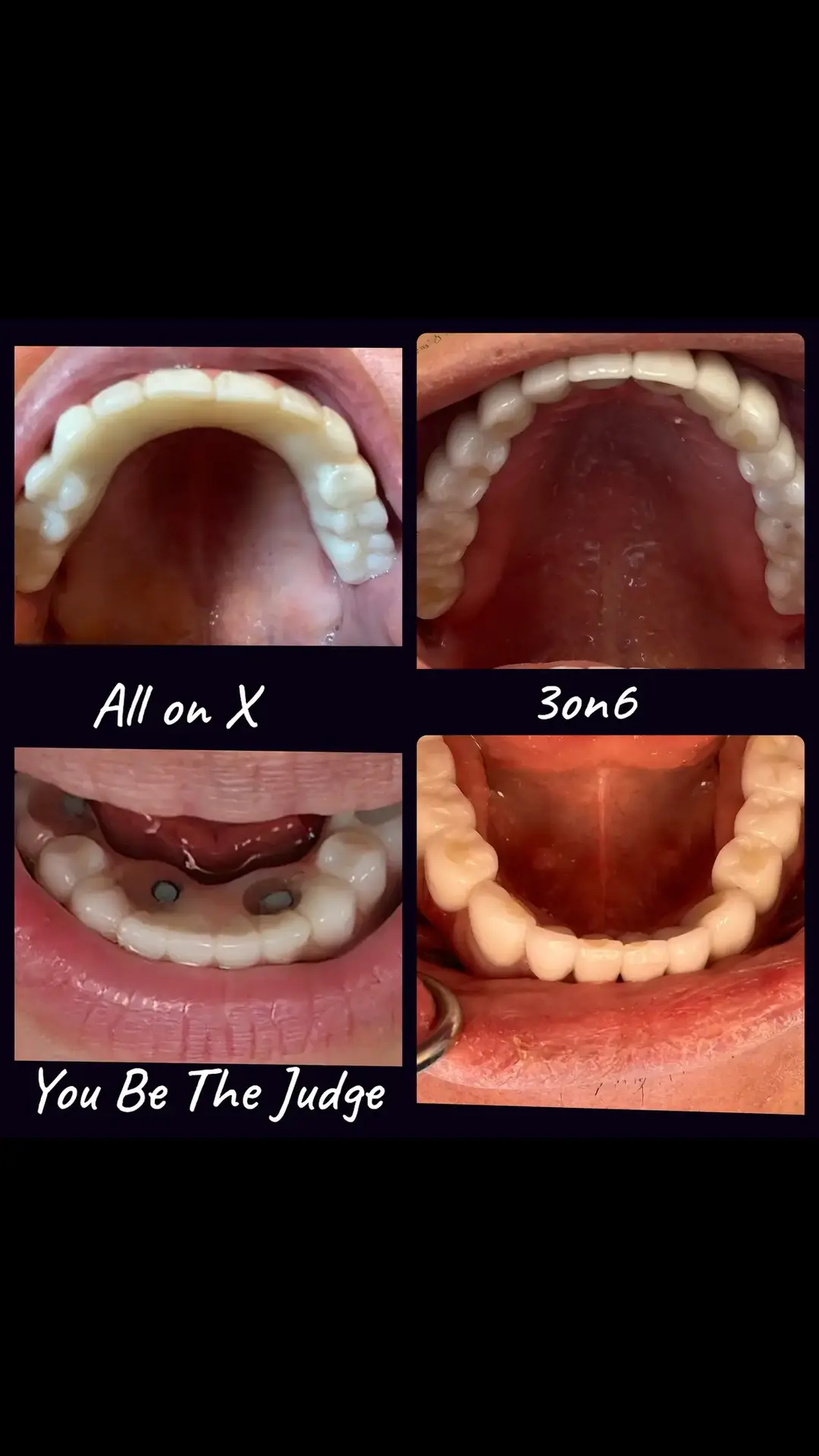 #3on6 #fullmouthrestoration #fullmouthimplant #savethebone #smilemakeover #smiletransformation #3on6providers #dentalimplants #permanentdentalimplants #allon4 #allonx #4on8 #dentures #smileclinic #beforeandafter @doc.locke @3on6 @smilesystems @smileclinic @utahsmileclinic @micah.weisenberg @lutter2323 #TRIimplants 