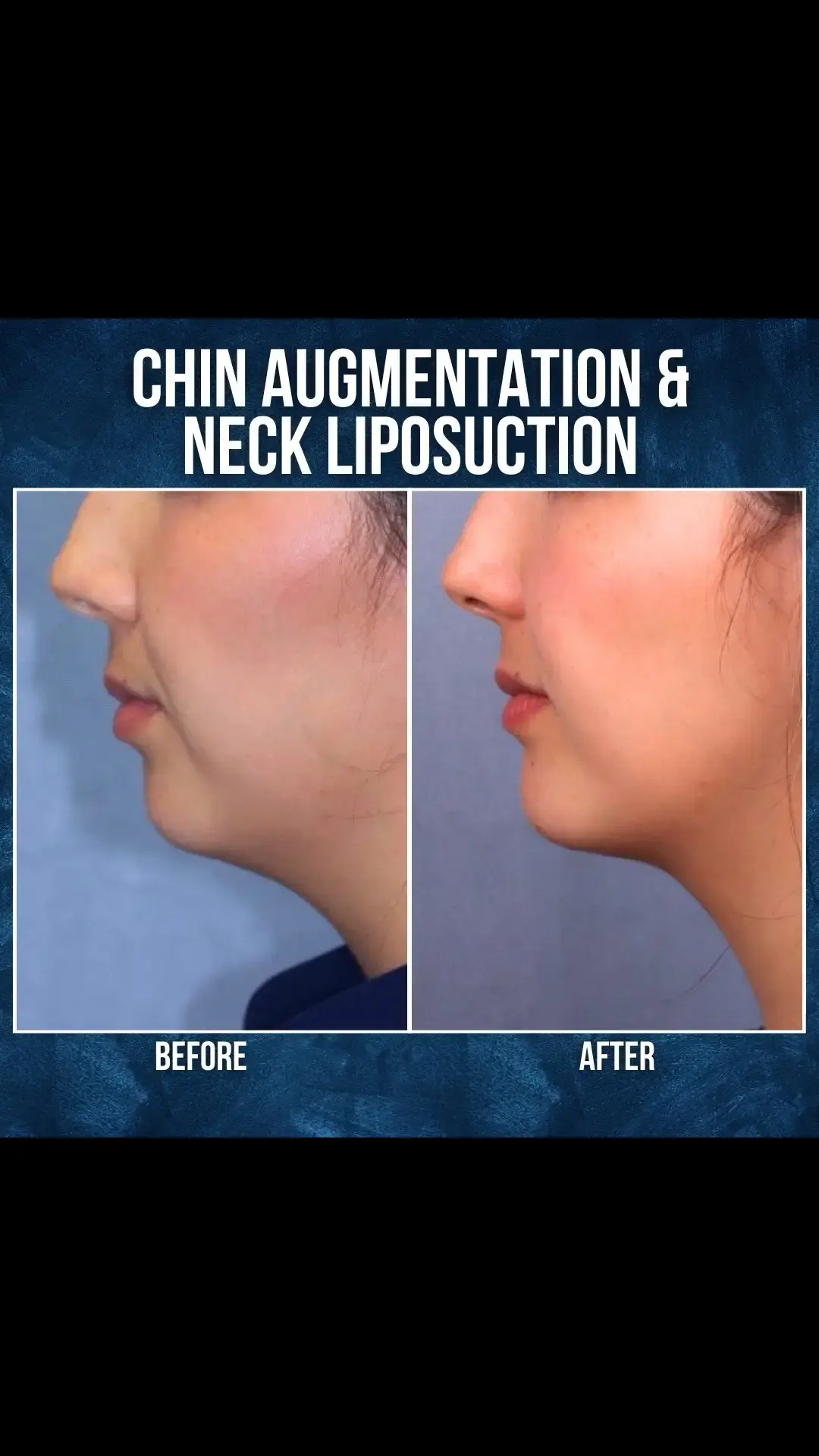 ✨ Confidence, defined. ✨ A subtle chin augmentation and neck liposuction can bring balance and harmony to your profile, enhancing your natural beauty. #chinaugmentation #facialcontours #confidenceboost #naturalresults #profileperfection #jawlinegoals #naturalenhancement #chinfiller #facialharmony #confidenceboost #nonsurgicalenhancement #aestheticmedicine #subtleenhancements #beautygoals #selfcarejourney #GlowUp #balancedprofile 