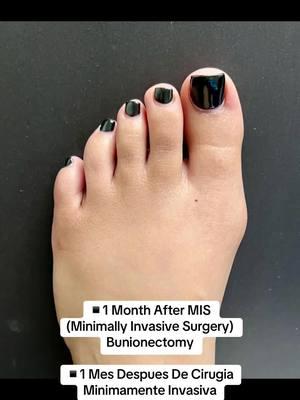 A BEAUTIFUL MINIMALLY INVASIVE BUNION TRANSFORMATION💗 👠Cosmetic Foot Surgery  🇪🇸Speak Spanish  🏖️Miami, Florida ☎️954 922 7333 📍Link In Bio  #fyp #bunions #bunionsurgery #juanetes #cirugiadejuanete #footsurgery 