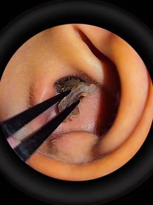 #earwax #relax #acne #satisfying #earwaxremoval #asmr #earcleaningvideos #ceradeouvido #earwaxcleaning #earwaxremmoval #limpezadeouvido 