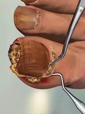 ingrown toenail treatment #toenail #ingrown #medical #removal #immersive #treatment #satisfying #care #asmr 