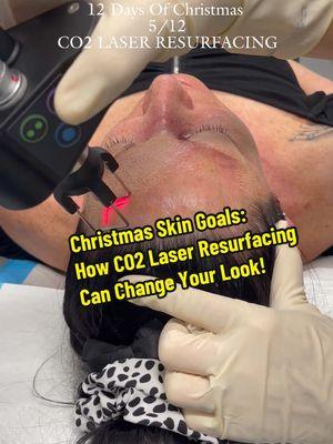 🎄 On the Fifth Day of Christmas: Let’s Check Out the Benefits of CO2 Laser Resurfacing!  As we dive deeper into the holiday season, it’s a great time to reflect not just on the joy that comes with the festivities, but also on how we can rejuvenate our skin for the new year ahead! One of the most effective treatments to consider is CO2 laser resurfacing. Let’s explore what makes it a standout option: Benefits of CO2 Laser Resurfacing: •	Reduces Fine Lines and Wrinkles •	Improves Skin Texture •	Diminishes Scars •	Evens Skin Tone •	Tightens Skin •	Long-lasting Results •	Customizable Treatment: Every skin type is unique! The procedure can be tailored to meet individual needs, ensuring optimal results for each patient. •	Quick Recovery: Although there may be some initial redness and swelling, recovery time is relatively short compared to more invasive procedures, allowing you to get back to your routine sooner. It’s essential to consult with a qualified dermatologist or skincare professional to discuss your options and determine the best approach for your skin type. Call or text 727-777-2640 Perich Aesthetics #CO2Laser #SkinResurfacing #YouthfulGlow #SkincareGoals #BeautyTreatment #LaserTherapy #FlawlessSkin #SkincareCommunity #HealthySkin #AestheticTreatments #12daysofchristmas