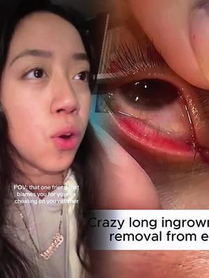 Ingrown eyelash removal with 25 gauge needle #ingrownhair #hairplucking #ingrowneyelash #lashes  #eyemucous #CleanTok #cleanmakeup #satisfyingvideo #asmr #eyemucous #cleaneyes #eyecleaning #sinkcleaningasmr #satisfying #asmrsound #asmr #cleanma  #fypage #fypシ゚ #fypツ #foryou #funny #skit #comedy #pov #fyp #foryou #tiktok #relatable 