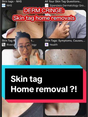 #skintag #skintagremoval #boardcertifieddermatologist #dermtips #skintagremovaltechnique #skintagremovals #amazonskincareproducts 