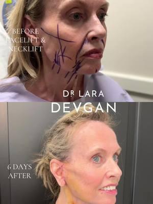 Understated elegance in #facelift and #necklift 📐📐📐 This is before and 6 days after surgery #plasticsurgeon #plasticsurgery #beautyisinthedetails #nyc 