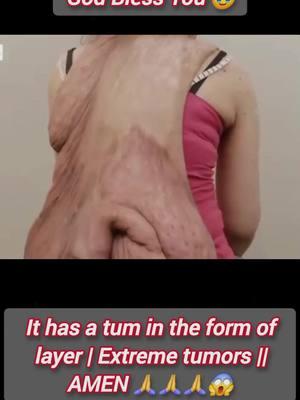 It has a tum in the form of layer | Extreme tumors || Amen 🙏🙏🙏 #tumor #conjoined #usa🇺🇸 #tiktok #conjoinedtwins #fyp #surgery #doctor #viral 