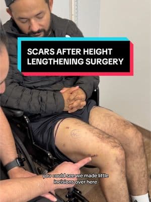 Replying to @Edgardo el locksmith scars after Height Lengthening surgery #tiktok #taller #height #limblengthening #tall #shortpeopleproblems #shortking #surgeonsoftiktok #surgery #short #heightlengthening #orthopedicsurgery #heightproblems #heightdifference #scars #tallman #fyp 