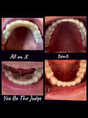 Which would you rather have in your mouth, the All on X, or the 3on6? #3on6 #fullmouthrestoration #fullmouthimplant #savethebone #smilemakeover #smiletransformation #3on6providers #dentalimplants #permanentdentalimplants #allon4 #allonx #4on8 #dentures #smileclinic #beforeandafter @doc.locke @3on6 @smilesystems @smileclinic @utahsmileclinic @micah.weisenberg @lutter2323 #TRIimplants 