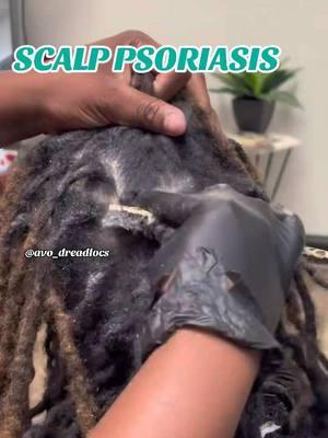 Scalp psoriasis is an autoimmune condition. It causes raised, discolored plaques on your scalp or on the skin around your scalp that may be dry, itchy and irritating. - -Client was treated for her Psoriasis. Even tho this does not have a cure, there are products that can used to reduce flares  - - Book your appointment today!! 📍Tampa Fl & Mcdonough Ga #tampalocs#fyp#atlloctician#viral#blowthisup#trending#Halloween 