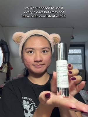 my update on using @VT Cosmetics US reedle shot 300 for the past two weeks 🌿 @VTcosmetics_official - products (except tatcha) are on @YesStyle, use code JENNILEE10 for 10% off orders over $49 :) - #vtcosmetics #reedleshot #reedleshot300 #skinupdate #morningskincare #morningroutine #acneskin #acneproneskin #oilyskin #texturedskin #hormonalacne #acneawareness #acnejourney #acnecommunity #cicareedleshot #foryou #fypage #asian #filipino #newyork #myhonestopinion 