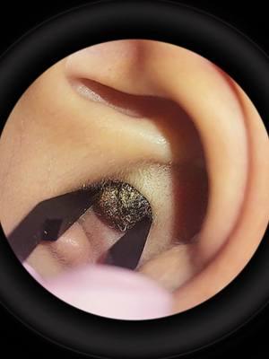 #earwax #relax #acne #satisfying #earwaxremoval #asmr #earcleaningvideos #ceradeouvido #earwaxcleaning #earwaxremmoval #limpezadeouvido 