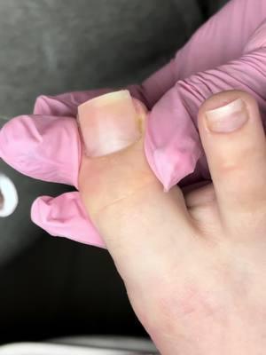 toe appliction 🦶#nycnailtech #nycnails #nycnailartist #toenail #toetech #toebbl #acrylictoes #nailartist #nailsoftiktok 