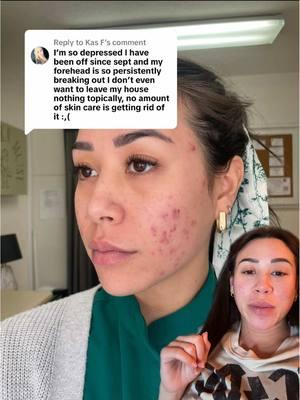 Replying to @Kas F #greenscreen you’ll get through it queen, stay positive ❤️❤️ #acnepositivity #acne #acnetreatment #acneskin #acneproneskin #acneskincare #postbirthcontrolsyndrome #postbirthcontrolacne #acnefighter #acnecheck 