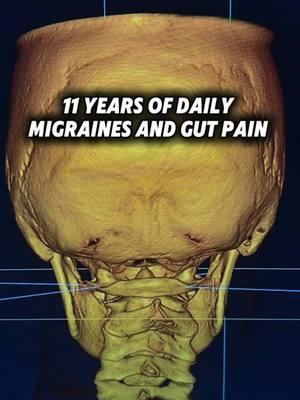 Are you suffering with a chronic health issue?  Can no one figure out why you’re suffering with:  • Migraines • Gut Issues  • Vertigo  • Anxiety  • Seizures  Does this describe you?  Comment below or message me if you need help or want answers.  #CapCut #vertigo #dizziness #uppercervical #guthealth #neckpain #medicalmystery #foryou #migraines #seizures #anxiety 