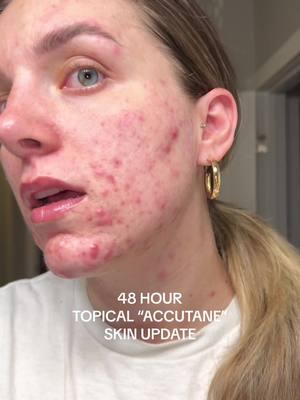 DAY 2 POST AEROLASE LASER UPDATE ON CYSTIC ACNE SKIN #acne #acneskin #acnetreatment #acnelaser #aerolase #facelaser #pcos #pcostreatment #unwantedhair #laserhair #laserhairremoval #pcosproblems #accutane #acnescars