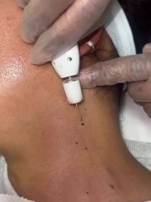 Skin Tag removal super easy and super fast process‼️ Are you worried and annoyed about skin tag ❓ But I want you to know that there is nothing to be worried and you too can have flawless tag free skin in few mins⁉️  No pain💃 no downtime 💃 instant result💃 📞 7184047048 to book an appointment.  . ✨✨✨✨✨ . Eliminación de etiquetas de piel proceso súper fácil y súper rápido‼️  ¿Estás preocupado y molesto por la etiqueta de piel ❓  Pero quiero que sepas que no hay nada de qué preocuparse y que tú también puedes tener una piel impecable y libre de marcas en pocos minutos⁉️  Sin dolor 💃 sin tiempo de inactividad 💃 resultado instantáneo 💃  📞 7184047048 para reservar cita. . . . . #skintag #skintagremoval #skintags #skintagsremoval #bronxnyc #bronxny #brooklynnyc #brooklynny #queensnyc #queensnyc # #longislandny #longislandcityqueens #astoriaqueens #coronaqueens #manhattannyc #manhatten #statenislandny #newrochelleny #weschester #baysideny #coneyislandnyc