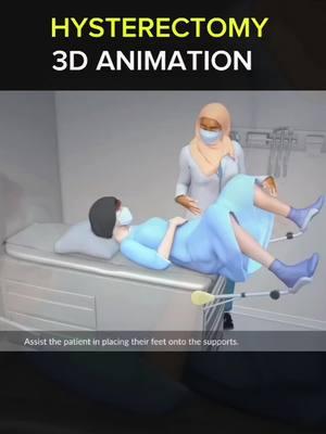 How to perform the hysterectomy: Your surgeon makes an incision inside your vagina to get to the uterus. Using long instruments, your surgeon clamps the uterine blood vessels and separates your uterus from the connective tissue, ovaries and fallopian tubes. #HysterectomyHealing #SurgeryRecovery #HysterectomyJourney #SurgicalProcedure #PostOpLife #hysterectomy #HysterectomyAwareness #SurgeryExperience #RecoveryProcess