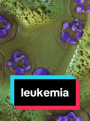 Let’s switch back to white blood cells for some #leukemiahistory and later we will add in some DNA history.  Here are the first cases of leukemia, likely #cml or #chronicmyeloidleukemia since #neutrophils were predominantly described #studentsofmedicine #medicalhistorybuffs #hematologyin3d 