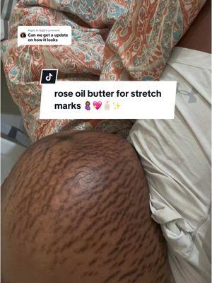 Replying to @Najjj I've been using Rose Oil Butter by Bodstry for just 25 days, and I've seen AMAZING results! 😍😍😍 Honestly, I thought I would have dark, loose skin forever… BUT Rose Oil Butter!!! You guys have to try their product and let me know how it works for you! 🥰🧴💖 @Bodystry #stretchmarks #postpartumbody #postpartumjourney #hyperpigmentation #skintransformation #skincare #skintreatment #mombody #mombodypositvity #weightlosstransformation #postpartumbelly 