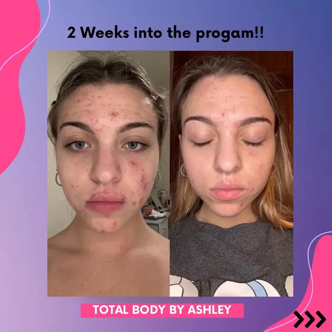 Your skin can be your biggest confidence boost!
‌ Nicole’s journey is just beginning, and she’s already seeing amazing results after completing my 2 week Flush Protocol. 🙌🏼
‌ She avoided Accutane ( that the doc recommended) and instead trusted a functional approach, and now we’re diving into her Gut Protocol for even more progress. 🌟
‌ If acne has you feeling defeated, comment ACNE below, and let’s start your journey to clear, glowing skin!
‌
‌ Ps -this was to good not to share! Thank you to my client for letting me share this 💜
‌
‌
‌ #ClearSkinJourney #GutHealthMatters  #AcneSupport #FunctionalHealth #HealthySkin #SkinConfidence #NaturalSolutions #HealingFromWithin #skincarejourney 